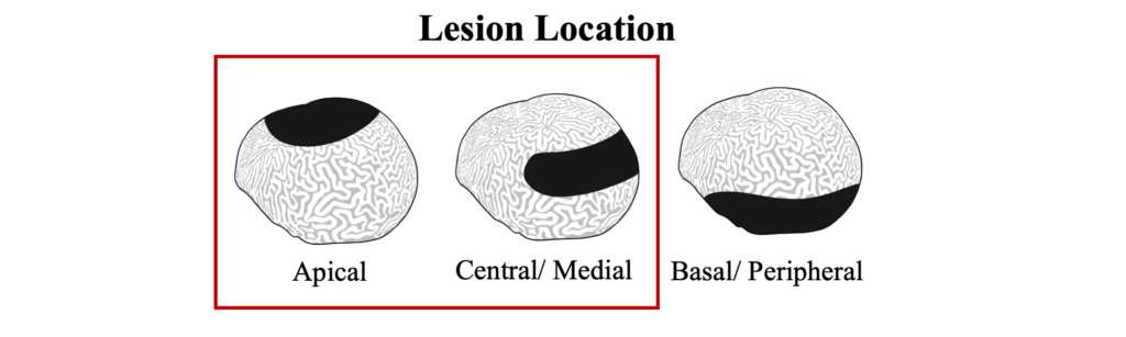 BBD Lesion Location