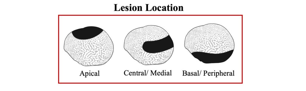 DSD Lesion Location