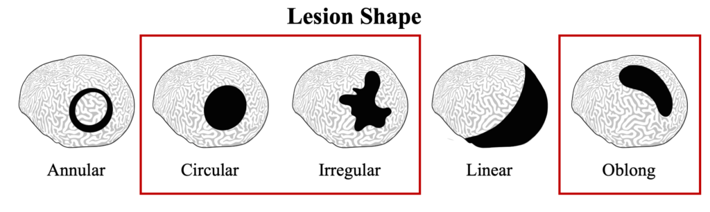 DSD Lesion Shape