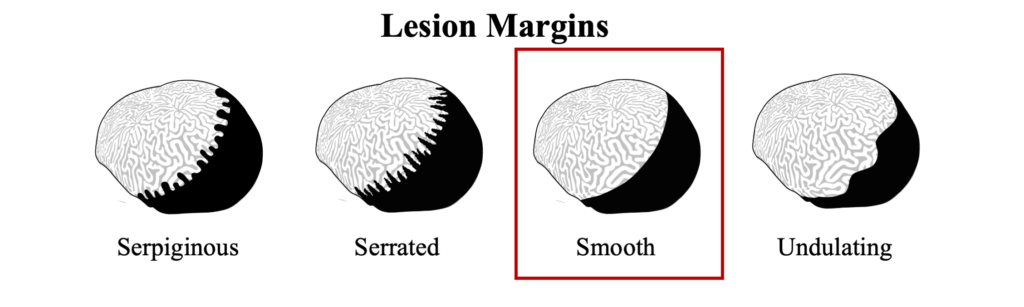 WBD Lesion Margin